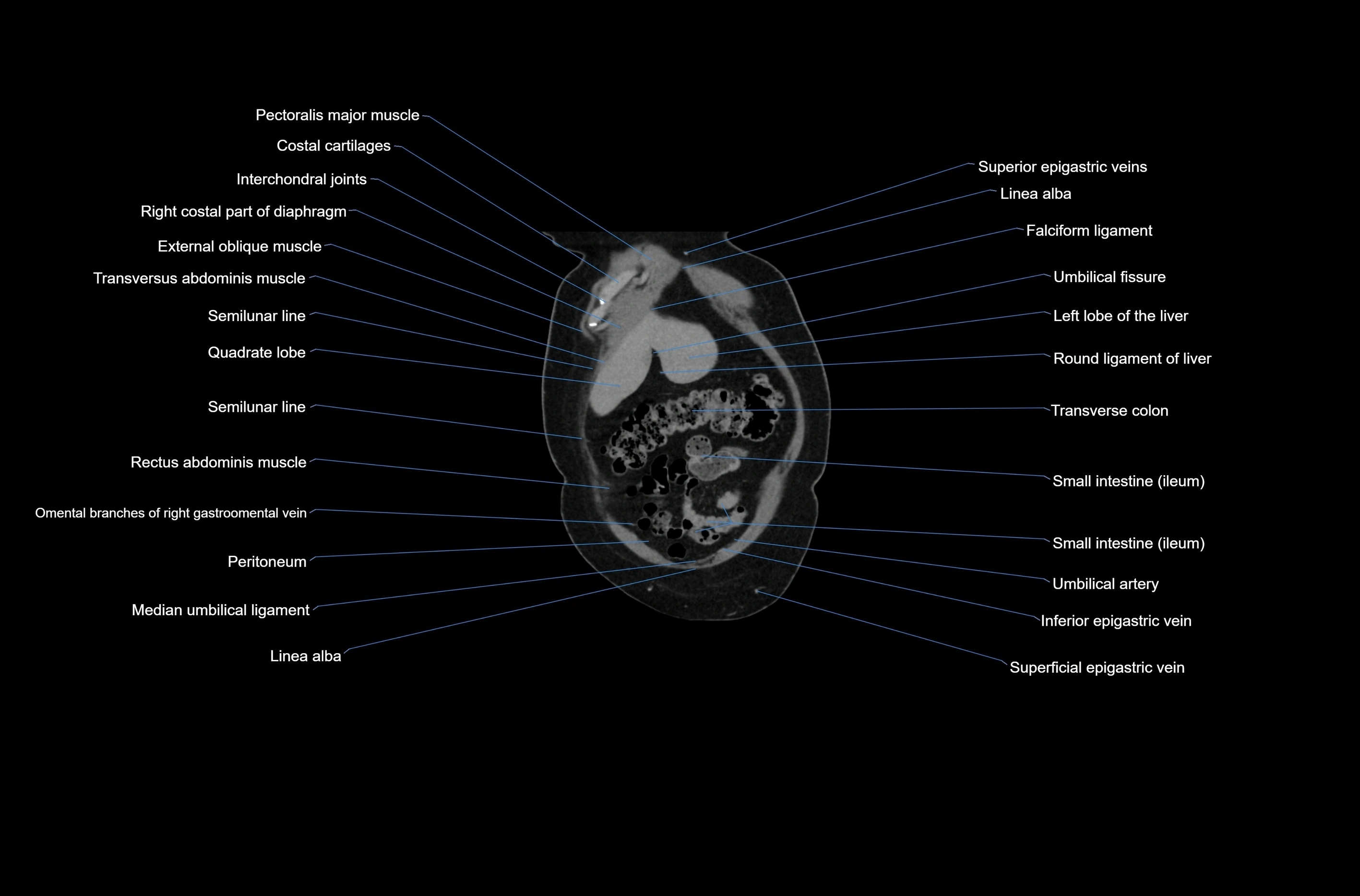 CT abdomen coronal cross sectional anatomy labelled radiology image-00012.webp